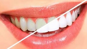 Diş Beyazlatma Tedavisi Nedir ?