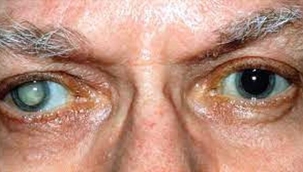 Katarakt Ameliyatı Bunama Riskini Azaltabilir...